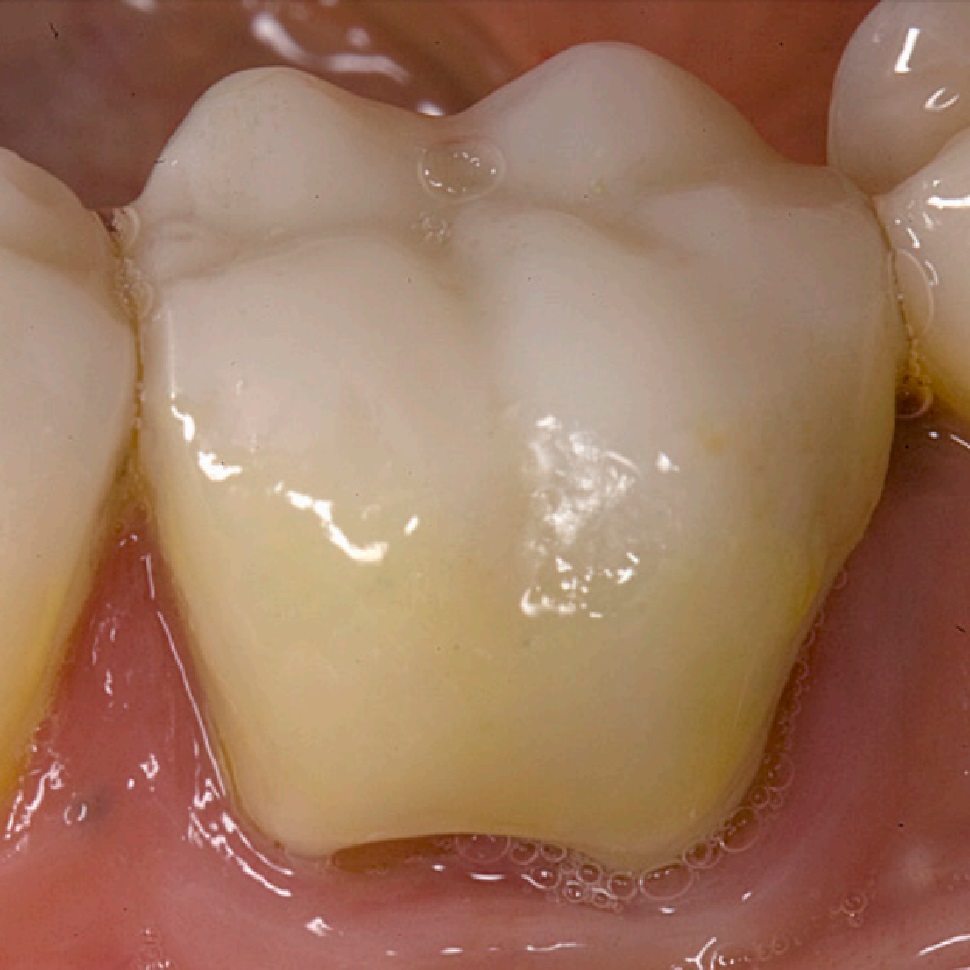 wypełnienia kompozytowe zębów