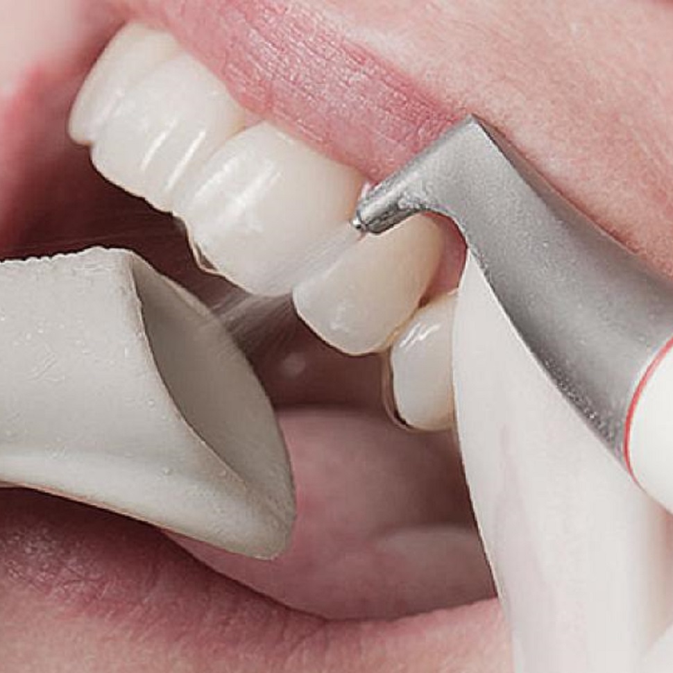 usuwanie osadów i przebarwień z zębów