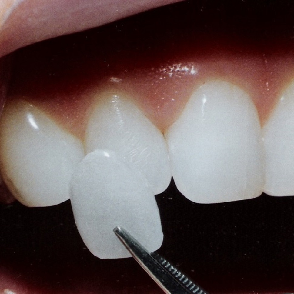 Микропротезирование передних зубов